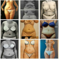 Liposuction Techniques Used in BBL: What You Need to Know