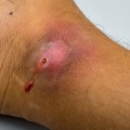 Signs of Infection to Watch Out For