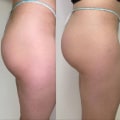 CoolSculpting for Fat Reduction: A Non-Surgical Alternative to Brazilian Butt Lift