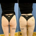 Butt Enhancement with Fillers: The Non-Surgical Alternative to a BBL