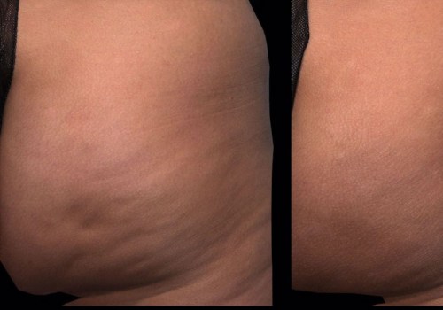 Exploring the Benefits of Laser Treatments for Cellulite Reduction