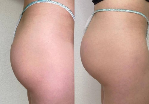 CoolSculpting for Fat Reduction: A Non-Surgical Alternative to Brazilian Butt Lift