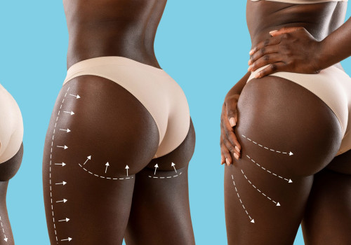 Post-Operative Care Tips for a Successful Brazilian Butt Lift