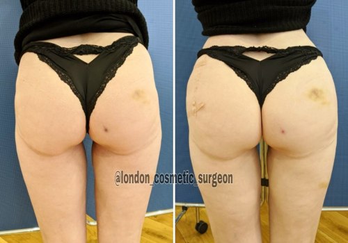 Butt Enhancement with Fillers: The Non-Surgical Alternative to a BBL