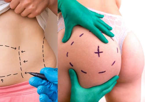 Combining a Tummy Tuck with a BBL: What You Need to Know